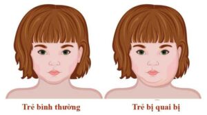 Bạn có thể nhận biết bệnh quai bị qua các biểu hiện sốt cao, mệt mỏi, chán ăn, đau mỏi toàn thân