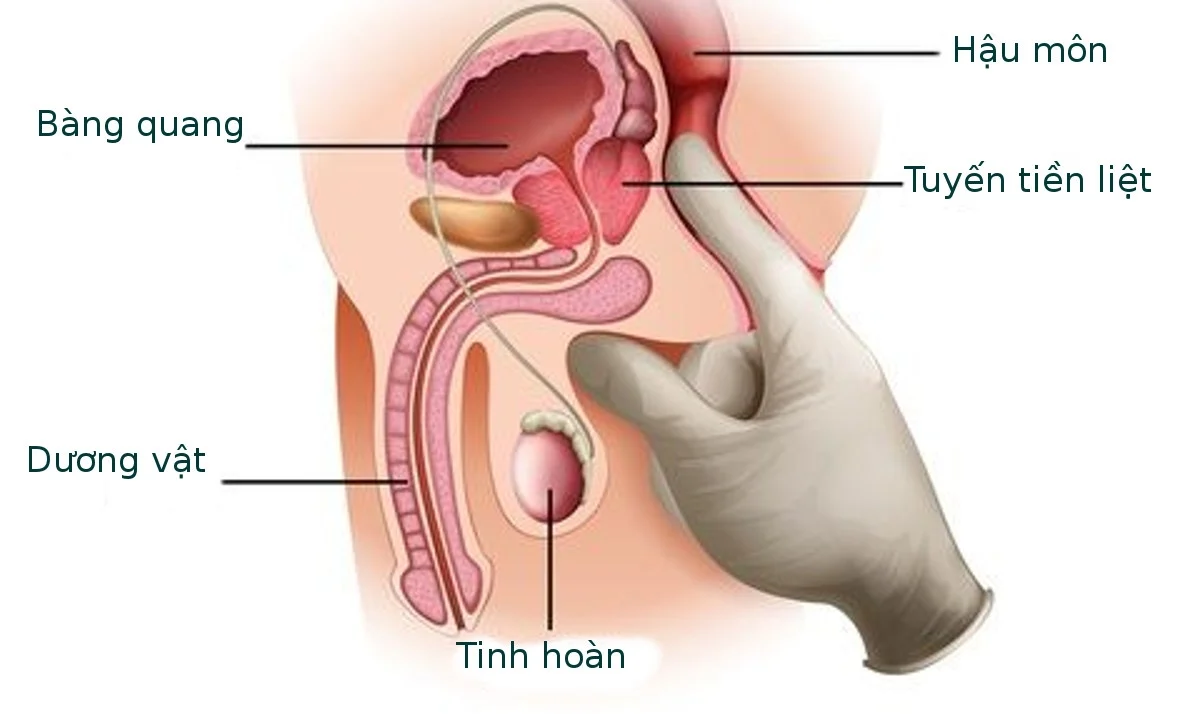 Ung thư tuyến tiền liệt gây ảnh hưởng nghiêm trọng đến chức năng tình dục và sức khỏe sinh sản của người đàn ông