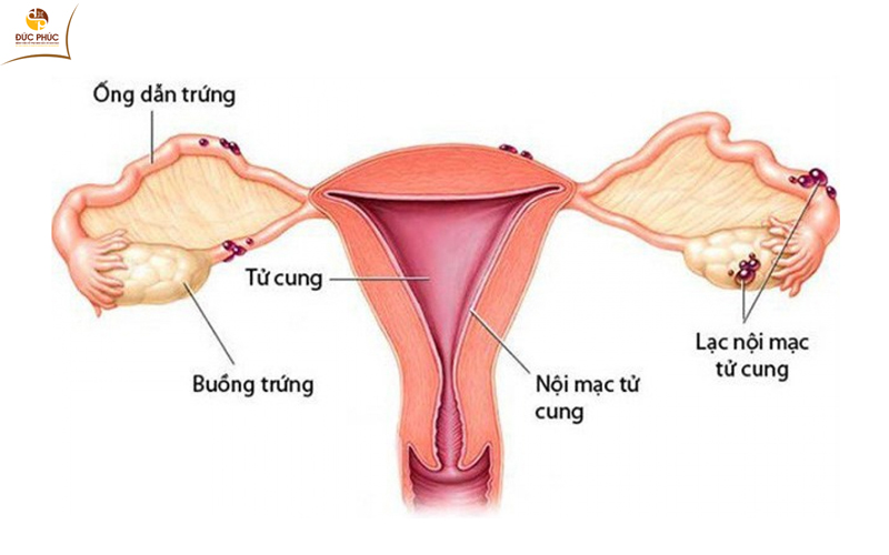 Căn bệnh lạc nội mạc tử cung ở nữ giới
