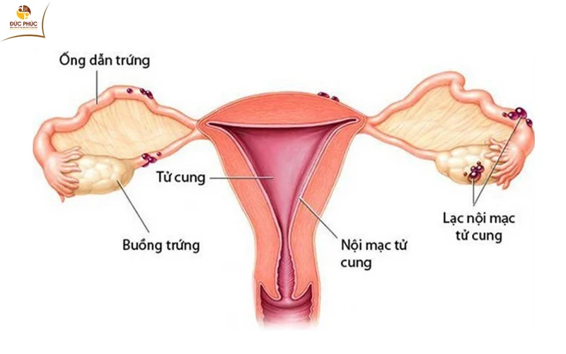 Căn bệnh lạc nội mạc tử cung ở nữ giới (Ảnh internet)