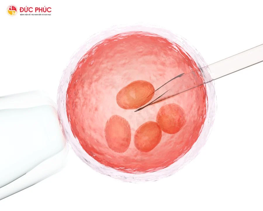 Chọc hút trứng là một trong những công đoạn quan trọng trong thụ tinh ống nghiệm