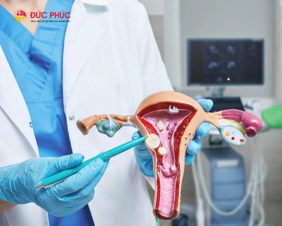 U xơ tử cung là một trong những vấn đề sinh sản được chỉ định làm thụ tinh ống nghiệm