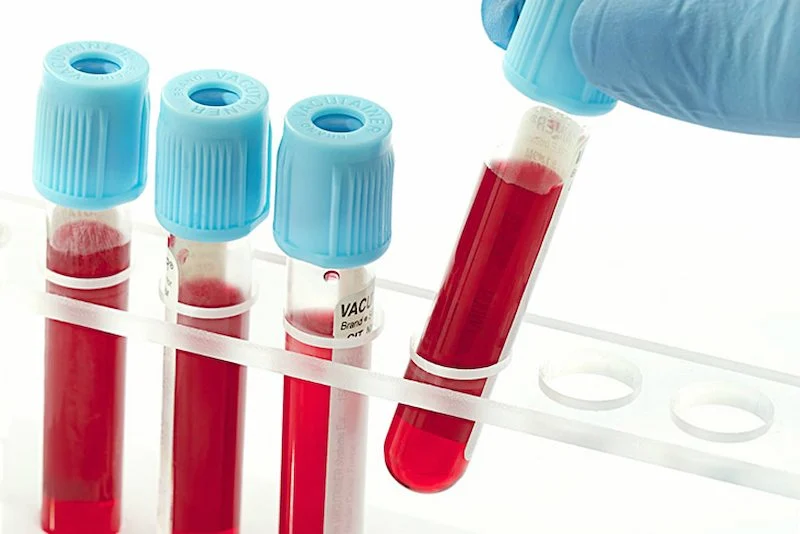 Thực hiện các xét nghiệm là một trong những lưu ý quan trọng mà người viêm gan B muốn làm IVF không nên bỏ qua
