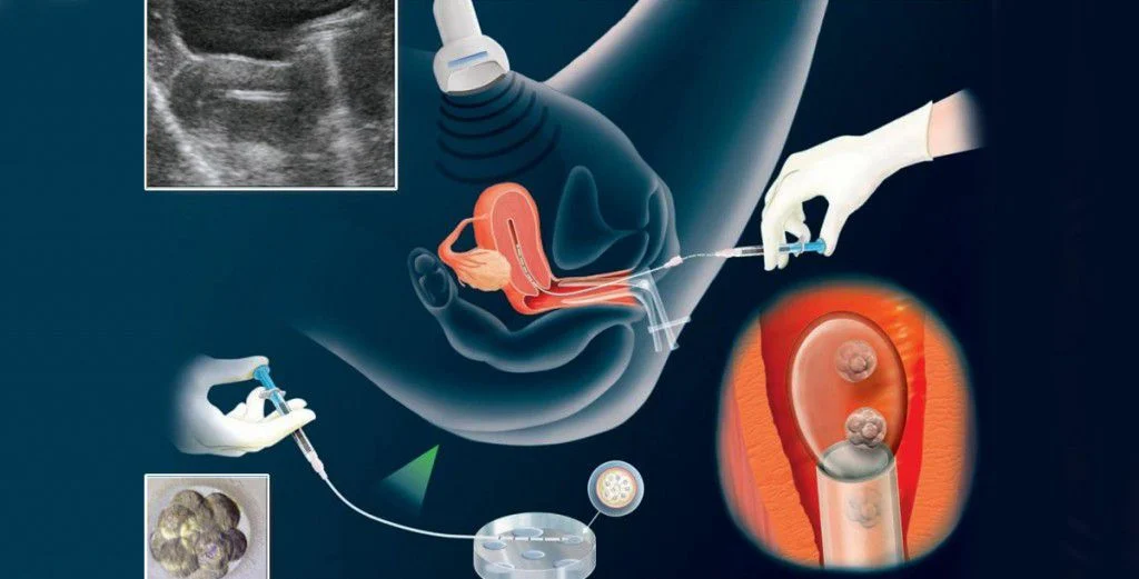 Bước “quyết định” trong quy trình thụ tinh ống nghiệm là chuyển phôi