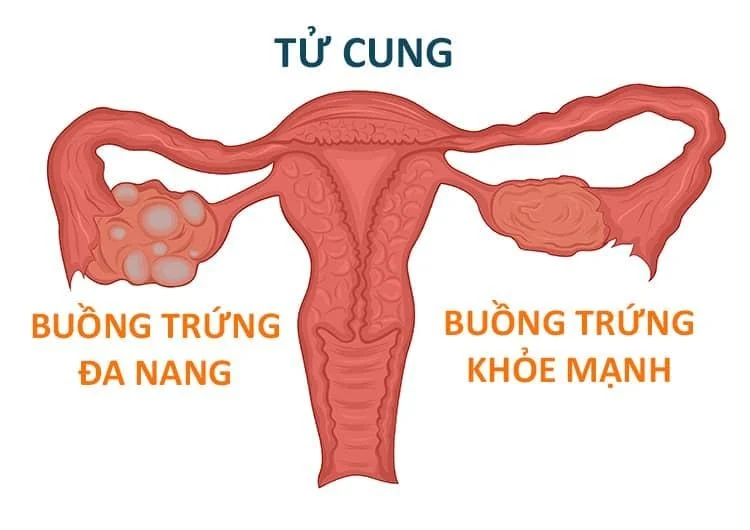 Buồng trứng xuất hiện nhiều nang nhỏ do nang noãn không phát triển được