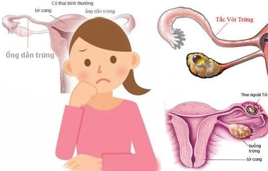 Tắc vòi trứng sẽ ảnh hưởng đến cơ chế rụng trứng giảm tỷ lệ thụ thai ở chị em