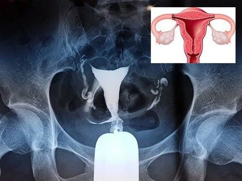 Chụp X-quang tử cung – vòi trứng để kiểm tra tình trạng bên trong tử cung và vòi trứng