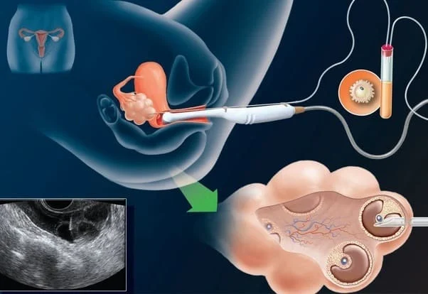 Thủ thuật chọc hút trứng sẽ được thực hiện khoảng 34-36 giờ sau khi tiêm kích rụng
