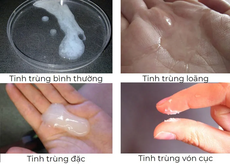 Tinh dịch loãng và ít là một trong những dấu hiệu phổ biến của tinh trùng yếu