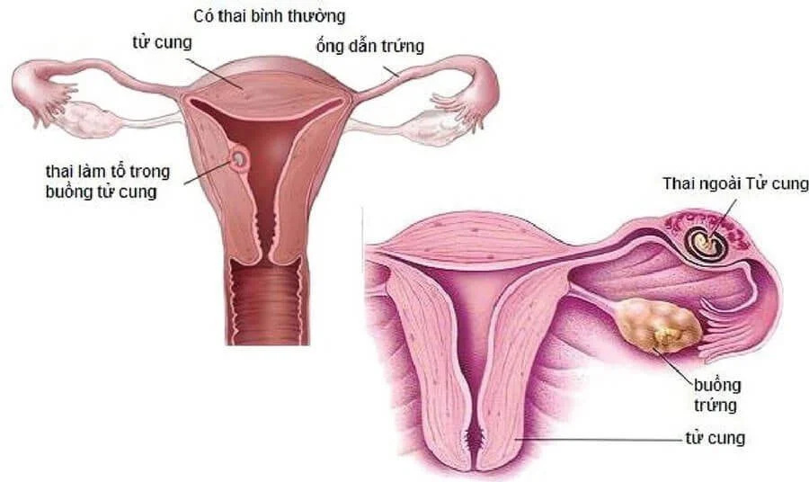 Vòi trứng nối thông từ buồng tử cung đến buồng trứng