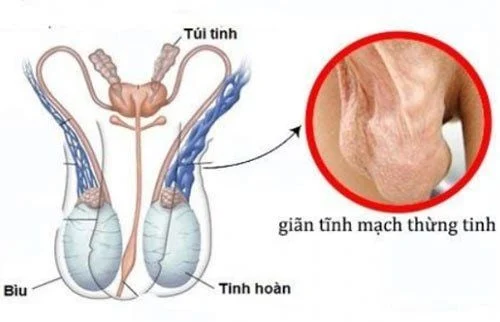 Các tĩnh mạch nằm trên tinh hoàn bị giãn nở, xoắn lại và phồng to do áp lực bên trong