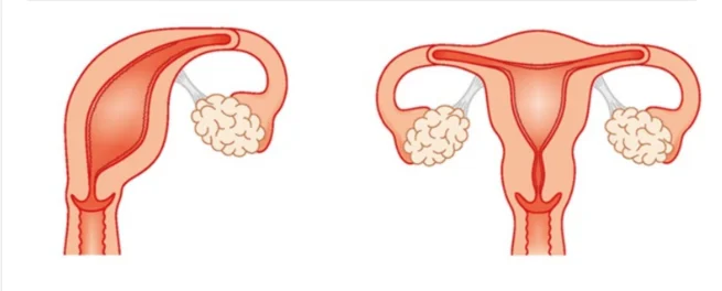 Phụ nữ mắc chứng tử cung một sừng thường gặp khó khăn trong việc thụ thai tự nhiên