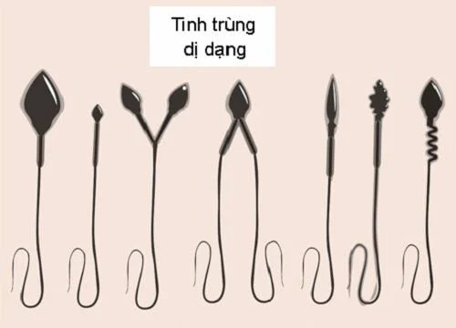 Tinh trùng dị dạng là những tinh trùng có hình dạng, kích thước hoặc cấu trúc không bình thường