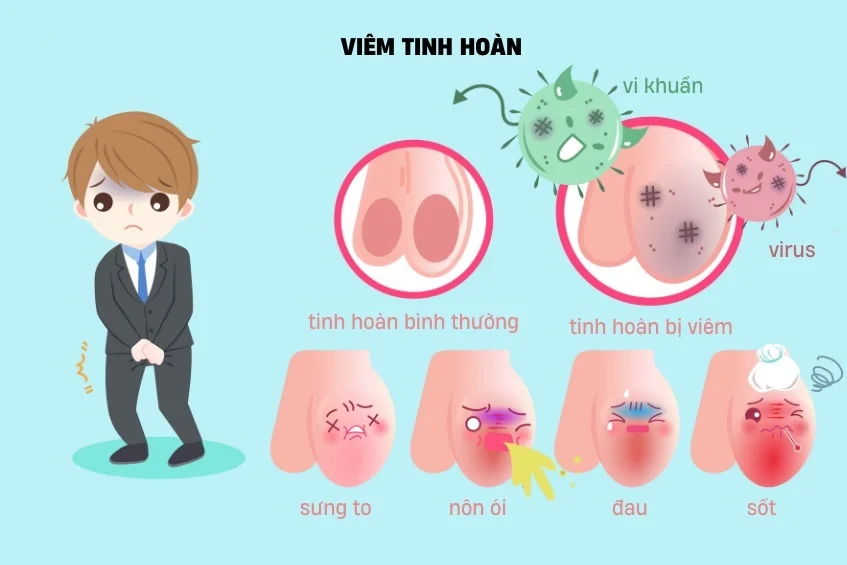 Triệu chứng điển hình của viêm tinh hoàn là cơn đau ở vùng tinh hoàn và háng.
