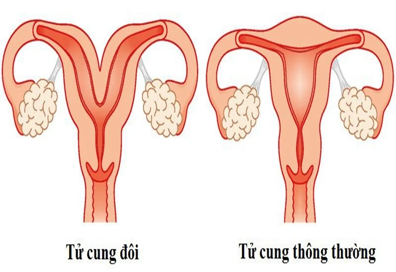 Tử cung đôi là một dị dạng tử cung hiếm gặp
