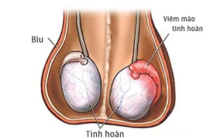 Viêm tinh hoàn là tình trạng viêm nhiễm xảy ra ở một hoặc cả hai bên tinh hoàn