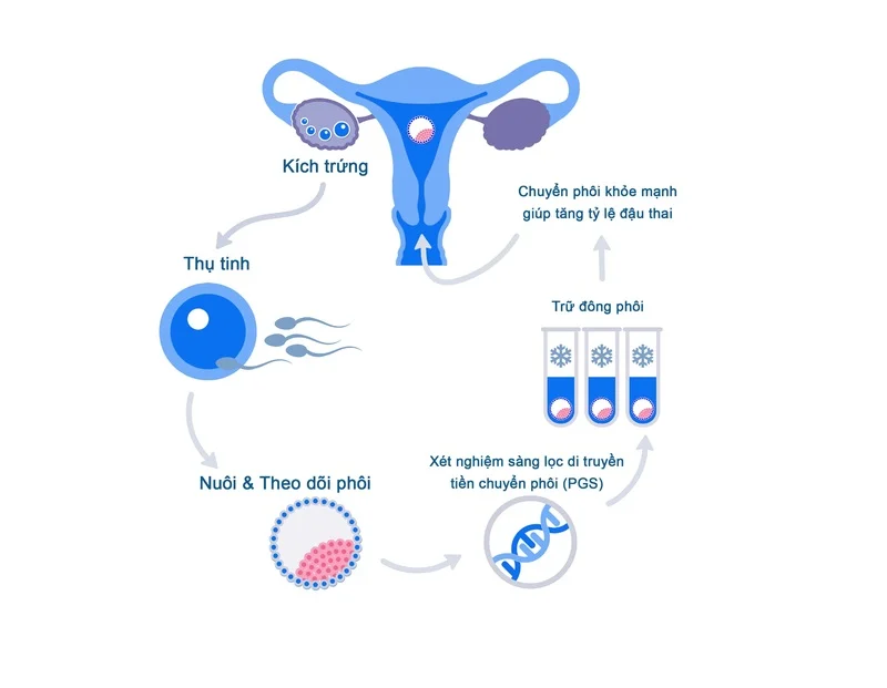 Chuyển phôi là một phần trong quy trình IVF