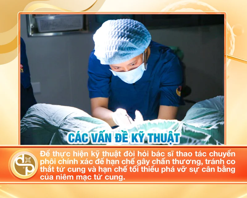 Kỹ thuật chuyển phôi cũng đóng một vai trò quan trọng trong việc quyết định sự thành công của quá trình IVF