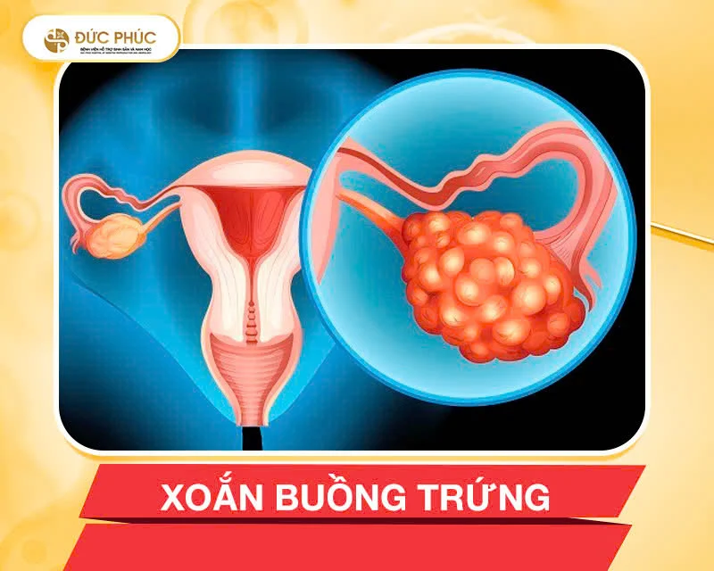 Đây là biến chứng hiếm nhưng nguy hiểm, xảy ra khi buồng trứng bị xoắn quanh dây chằng do tăng kích thước