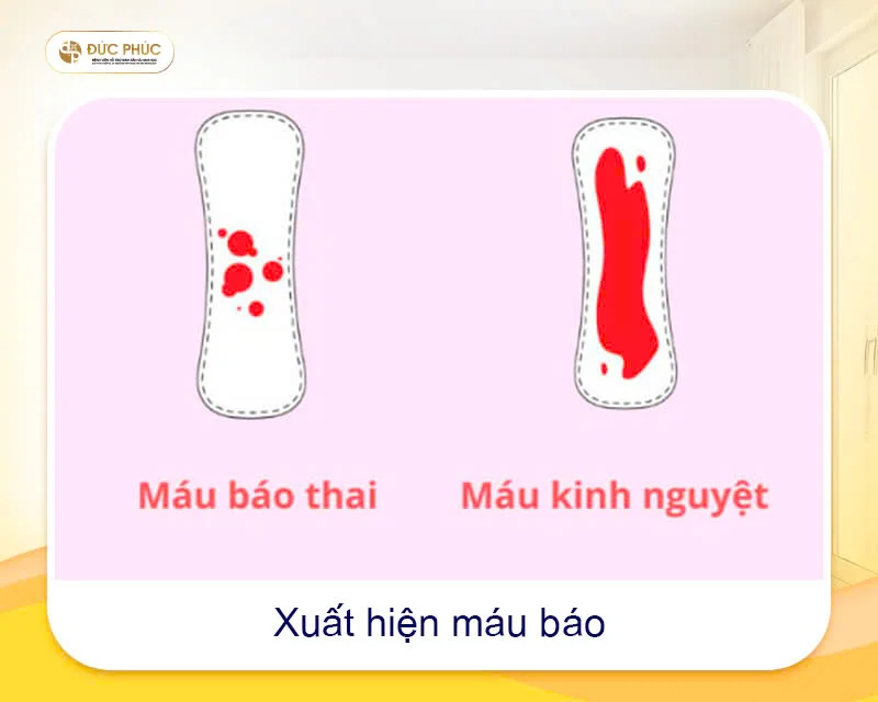 Một trong những dấu hiệu thành công sau khi chuyển phôi IVF  là sự xuất hiện của máu báo