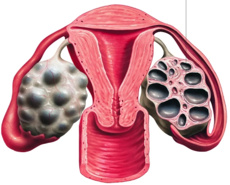 một biến chứng đáng chú ý là hội chứng quá kích buồng trứng.