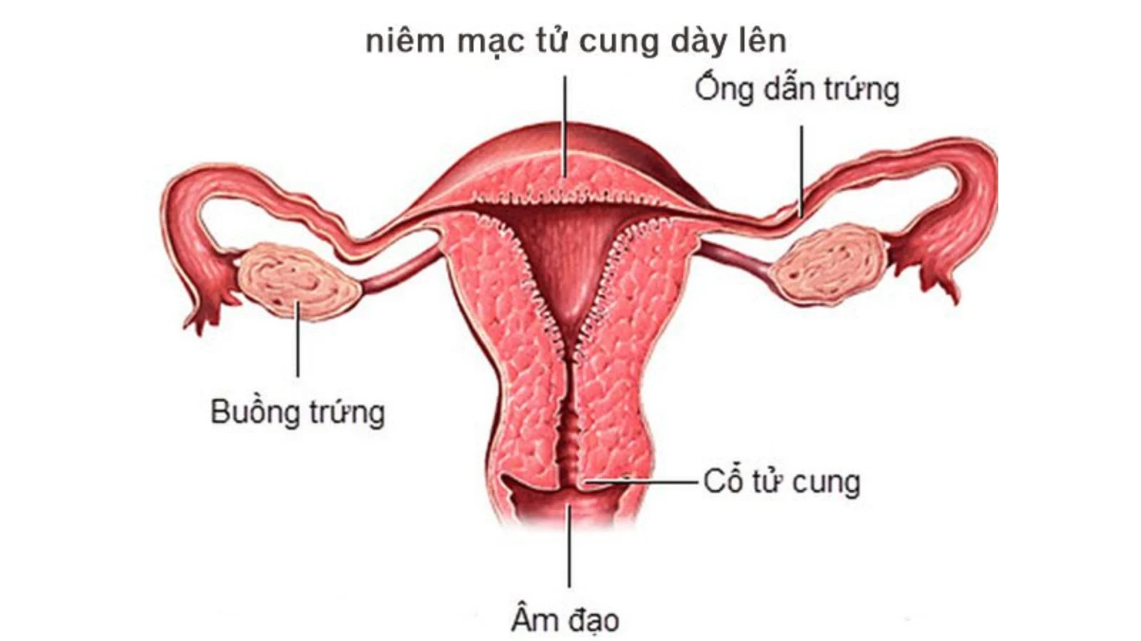 Niêm mạc tử cung là lớp mô mềm bao phủ toàn bộ mặt trong của tử cung