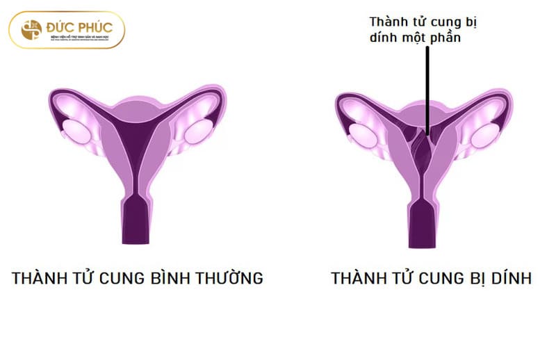 Dính buồng tử cung nhẹ