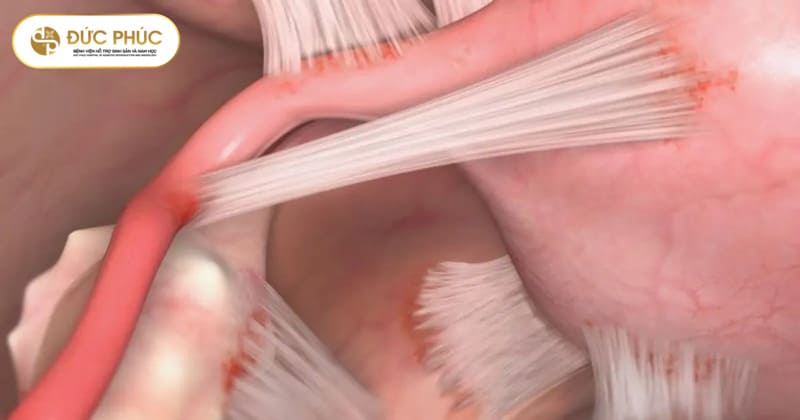 Nội soi chẩn đoán dính buồng tử cung