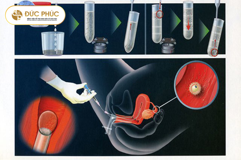 Nhiều phương pháp chữa vô sinh hiện nay