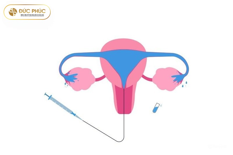 Làm IVF có cần chụp tử cung vòi trứng không