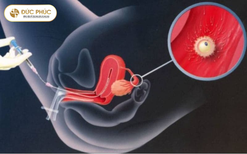 Chuyển phôi IVF là gì?