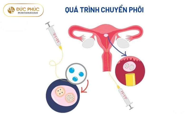 Quy trình chuyển phôi IVF vào buồng tử cung diễn ra thế nào?