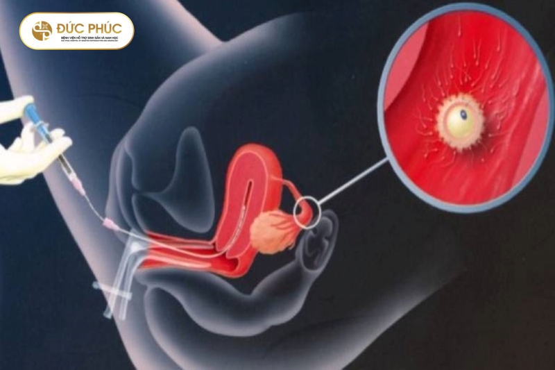 Thực hiện IUI không can thiệp nhiều nên chi phí khá hợp lý