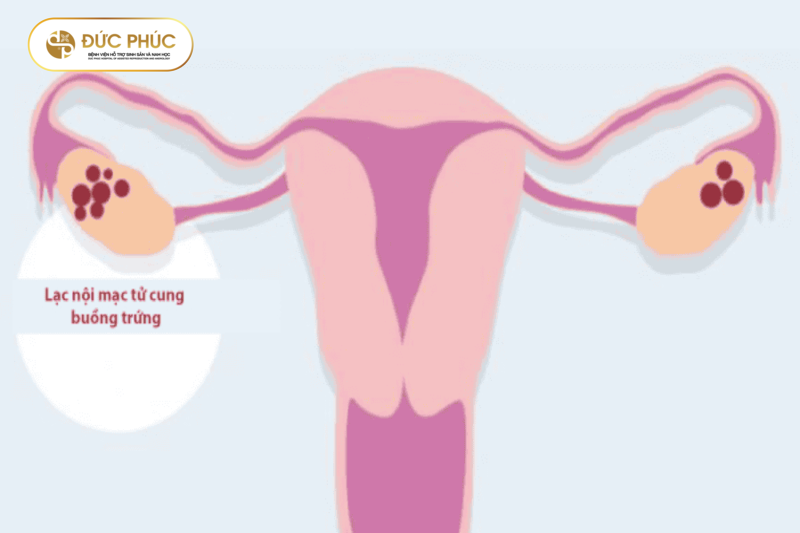 Phương pháp IUI phù hợp cho đối tượng vô sinh nhẹ