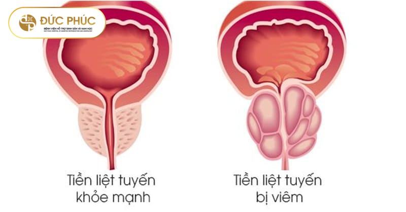 Viêm tuyến tiền liệt là gì?
