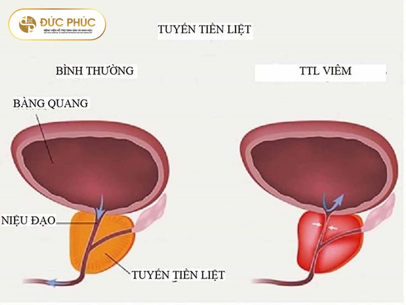 Các loại viêm tuyến tiền liệt