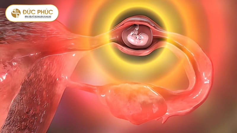 Thai ngoài tử cung sau IVF là gì?