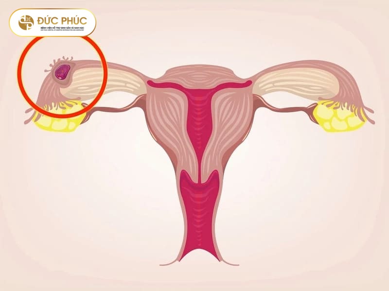 Thai ngoài tử cung sau IVF có nguy hiểm không?