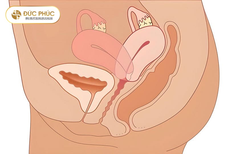 Tử cung ngả sau IVF là gì?
