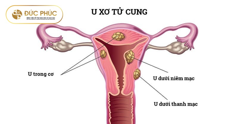 U xơ tử cung là nguyên nhân gây tử cung ngả sau IVF