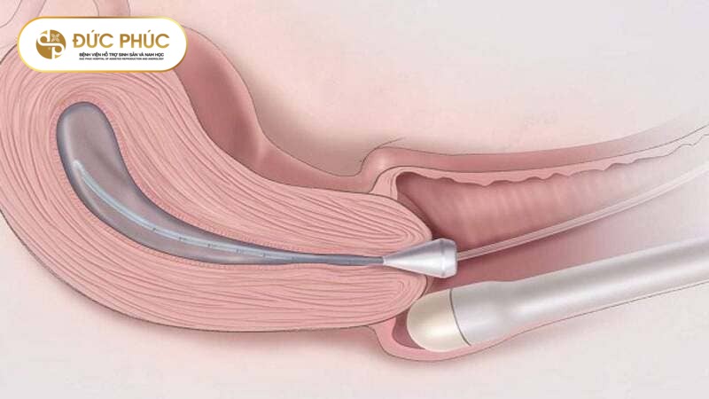 Chẩn đoán tử cung ngả sau IVF qua siêu âm tử cung